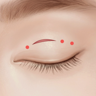 Partial incision