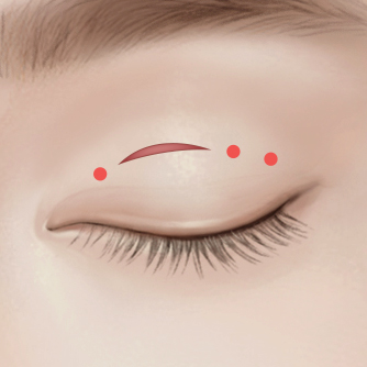 부분절개 눈매교정