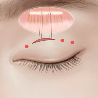 부분절개 눈매교정