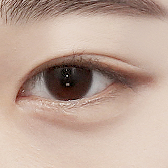 부분절개 눈매교정