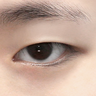 비절개 눈매교정