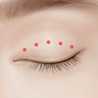 비절개 눈매교정