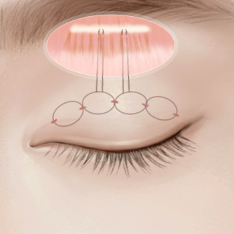 비절개 눈매교정