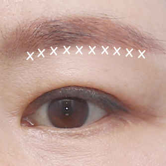 Under-brow resection
