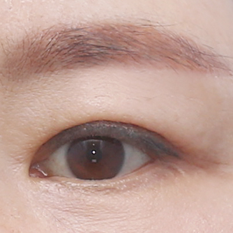Under-brow resection