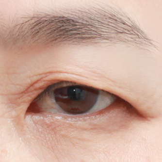 Upper blepharoplasty