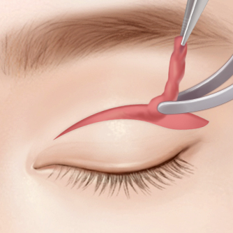Upper blepharoplasty