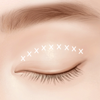 Upper blepharoplasty