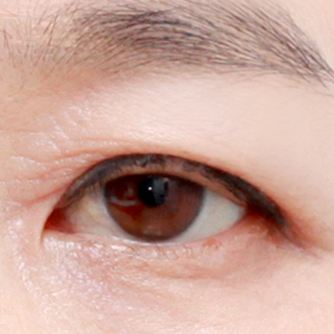 Upper blepharoplasty