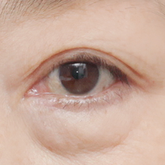 Lower blepharoplasty