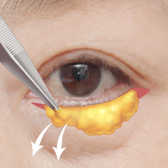 Lower blepharoplasty