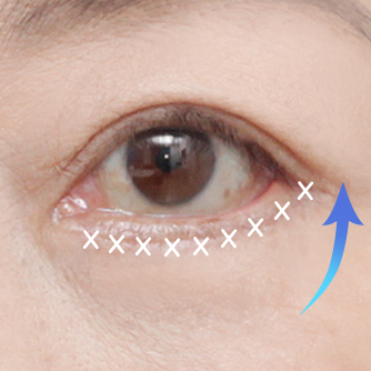 Lower blepharoplasty