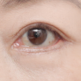 Lower blepharoplasty