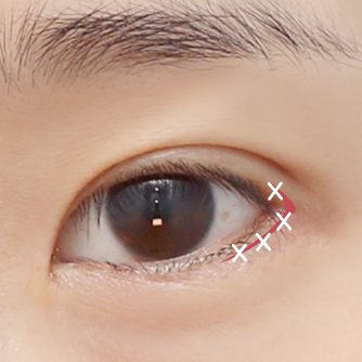 dual epicanthoplasty