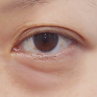 Under-eye bags fat repositioning