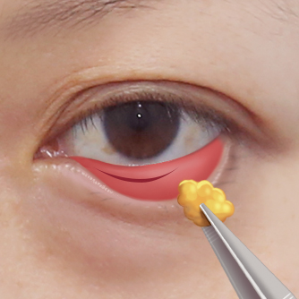 Under-eye bags fat repositioning