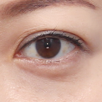 Under-eye bags fat repositioning