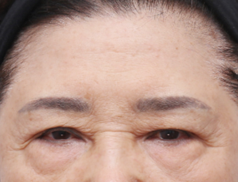 Forehead lift(Endoscopic eyebrow lifting)