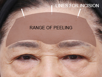 Forehead lift(Endoscopic eyebrow lifting)
