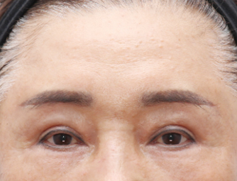 Forehead lift(Endoscopic eyebrow lifting)