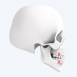 Tooth extraction