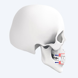 Gum bone repositioning