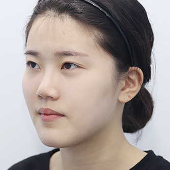 Long-curved square jaw surgery