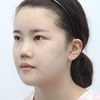 Long-curved square jaw surgery