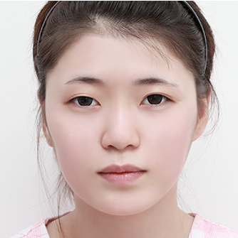 Cheekbone reduction