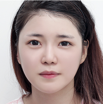 Cheekbone reduction