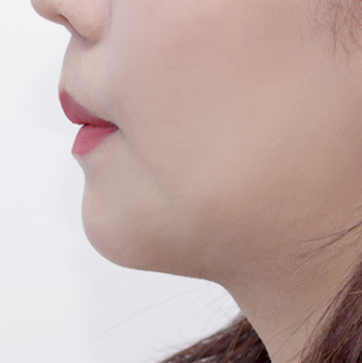 Chin tip surgery