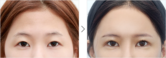 before and after