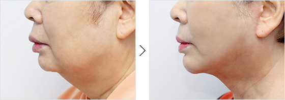 before and after