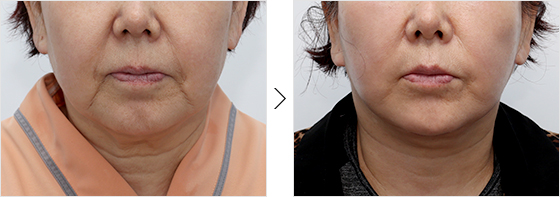 before and after