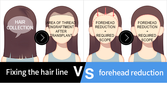 헤어라인고정 VS 이마축소고정